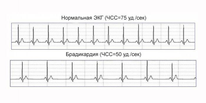 bradikardiya prichiny vozniknoveniya simptomy diagnostika i lechenie 11